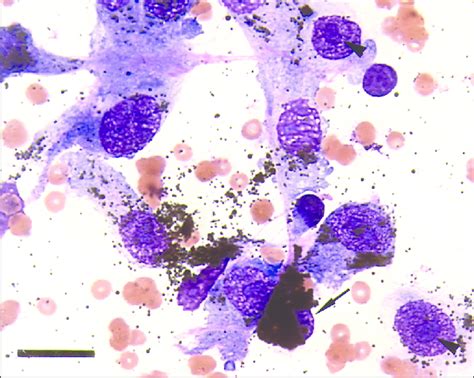 anisocytosis and anisokaryosis.